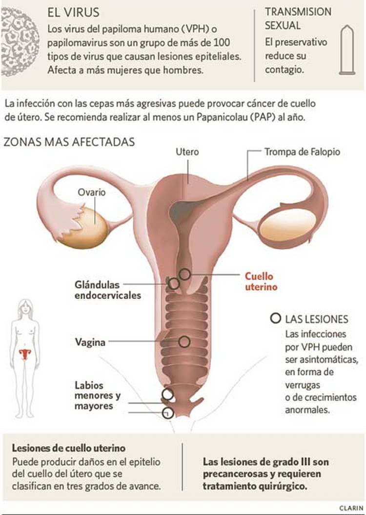 verrugas genitales en hombres benignas verrugas genitales en hombres benignas